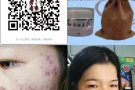 【苗家秘制祛痘膏】效果是写在脸上。