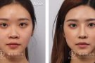海鷗線拉提成就精緻美鼻