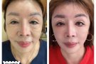 81萾YlNG 国际贸易医疗美容抗衰减肥TBL一分钟祛眼袋