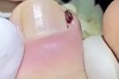 专业治疗甲沟炎