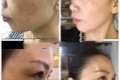 痘痘的克星