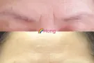 Eyebrow embroidery 