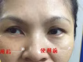 去除眼袋！去除黑眼圈！就是這麼簡單 【三分鐘見效】微信：3214985723 