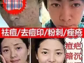 痘痘的克星