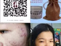 【苗家秘制祛痘膏】效果是写在脸上。