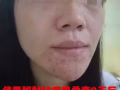 【苗家秘制祛痘膏】效果是写在脸上。