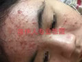 苗家祛痘膏