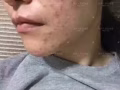 苗家祛痘膏