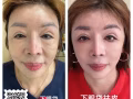 81萾YlNG 國際貿易醫療美容抗衰減肥TBL一分鐘祛眼袋