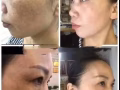 痘痘的剋星